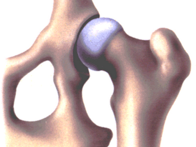 Tettoplastica acetabolare nella displasia dell'anca: tecnica modificata